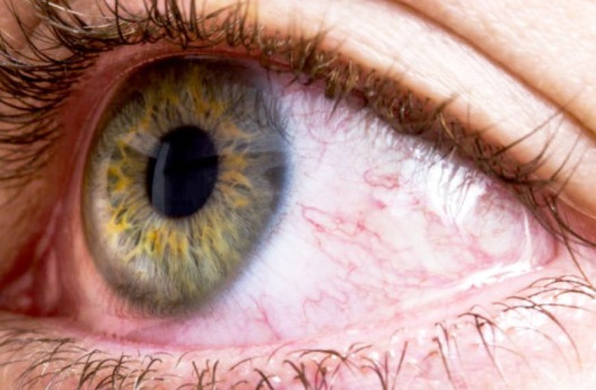 Inflammation de la Conjonctive : Attention, les yeux voient rouges !