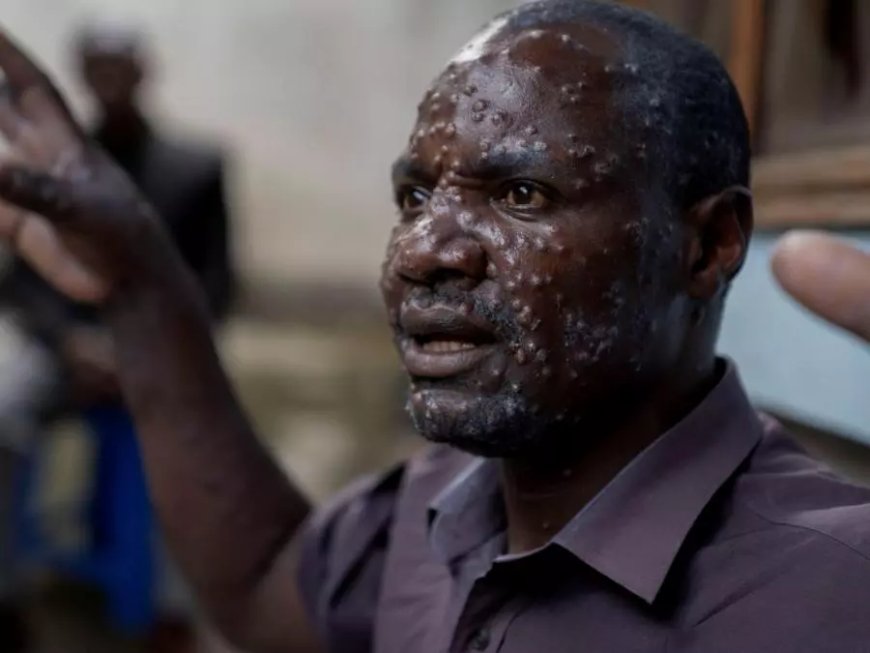 L’OMS appelle tous les pays à lutter ensemble contre le Mpox