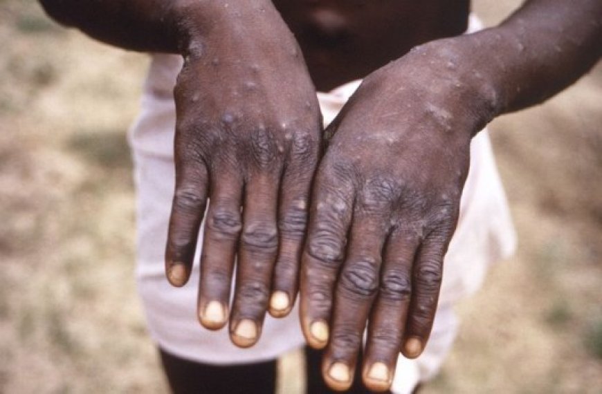 Réponse au Mpox : Plus de 800 millions de dollars promis