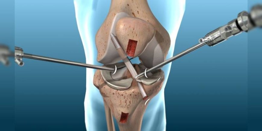 Hôpital d’Aïn Sefra : Une première opération de reconstruction du ligament croisé antérieur par arthroscopie