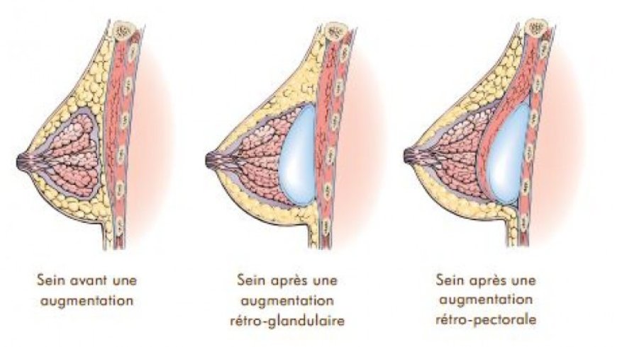 La pose de prothèses mammaires
